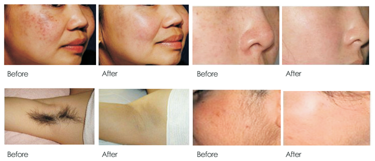 Beauty Salon RF Elight Ipl Hair Removal And Skin Rejuvenation Machine OEM ODM