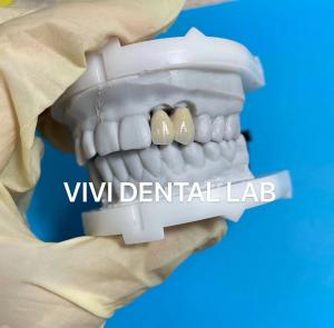 China Ni Be Free Digital Dental Crowns Accurate Metal Ceramic Crowns on sale